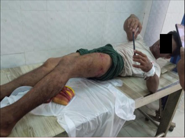 အုတ်ဖိုမြို့နယ်၌ သေနတ်ဖြင့် ပစ်ခတ်ခံရ၍ အမျိုးသား ၁ ဦး ဒဏ်ရာရရှိမှု။