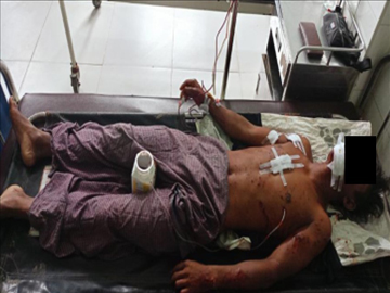 A male was injured by a homemade mine explosion in Shwebo Township.