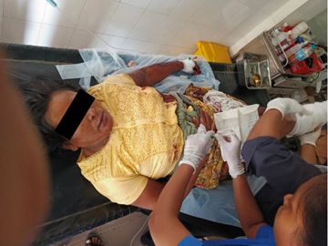 A woman injured by an explosion near Taung Ywar Ma Village in  Seikphyu Township, Magway Region.