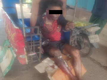 A man injured in a drone bomb attack by insurgents committing terrorist activities.