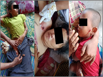 Three innocent civilians injured by drone-dropped bomb explosions in Kyun Kone Village, Kyaikmaraw Township of Mon State.