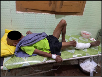 A man injured by an explosion in Taw Wi Village, Nyaunglebin Township of  Bago Region.