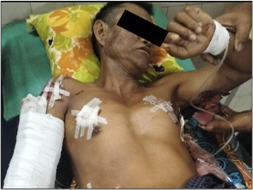 Innocent Civilian Injured in Heavy Weapon Attack by Armed Terrorists in   Htantabin Township of Bago Region.