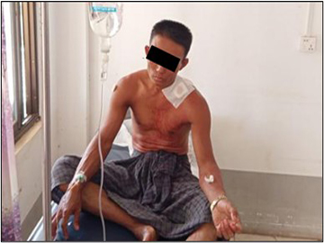 Ward Administrator was injured in attack by so-called PDF terrorists  in Gyobingauk Township of Bago Region.