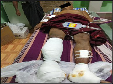 A monk was injured after stepping on an explosive device planted by a so-called PDF terrorist faction in Pakokku Township of Magway Region.