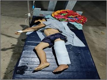 A child was injured in heavy weapon attack by KIA insurgents and  so-called PDF terrorists in Waingmaw Township of Kachin State.
