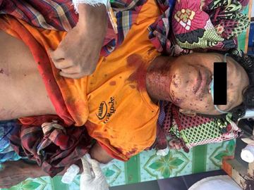 An innocent civilian was injured after stepping on an explosive device planted by a so-called PDF terrorist group in Shwebo Township of Sagaing Region.