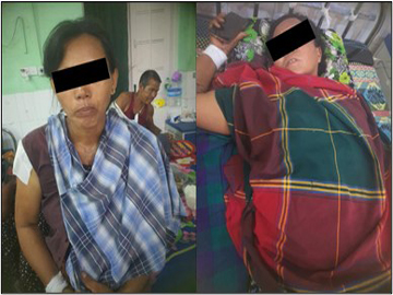စစ်ကိုင်းတိုင်းဒေသကြီး၊ အရာတော်မြို့နယ်၌ အကြမ်းဖက်အဖွဲ့(စိစစ်ဆဲ)က ကျေးရွာအတွင်းသို့ လက်နက်ကြီးဖြင့် ပစ်ခတ်တိုက်ခိုက်ခဲ့မှုကြောင့် အပြစ်မဲ့ အရပ်သားပြည်သူ နှစ်ဦး ထိခိုက်ဒဏ်ရာရရှိမှု မှတ်တမ်းဓာတ်ပုံ။