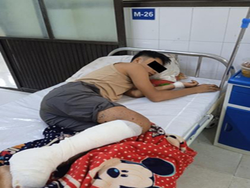 An innocent civilian injured in a heavy weapon attack by a terrorist group in Naungcho Township of Northern Shan State.