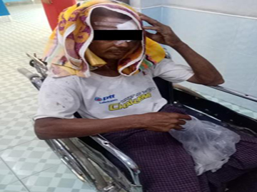 An innocent civilian injured after explosion device planted by a so-called PDF terrorist group in Yaenanchaung Township of Magway Region.