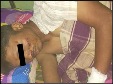 A member of people’s militia was injured after stepping on an explosive device planted by a so-called PDF terrorist group in Pauk Township of Magway Region.