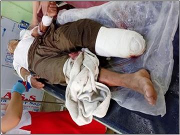 An innocent civilian injured after stepping on an explosive device planted by a terrorist group  in Hpa-An Township of Kayin State.
