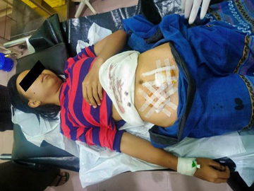 An innocent civilian injured in a drone bomb attack by a so-called PDF terrorist group in Seikphyu Township of Magway Region.