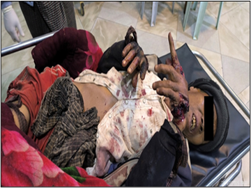 An innocent civilian injured in a heavy weapon attack by a terrorist group in  Naungcho Township of Shan State.