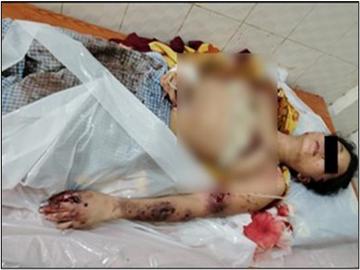 ပဲခူးတိုင်းဒေသကြီး၊ အုတ်ဖိုမြို့နယ်၌ ဗုံးသီးဟောင်း တစ်လုံး ပေါက်ကွဲခဲ့မှုကြောင့် အပြစ်မဲ့ အရပ်သားပြည်သူ တစ်ဦး ထိခိုက်ဒဏ်ရာရရှိမှု မှတ်တမ်းဓာတ်ပုံ။ 