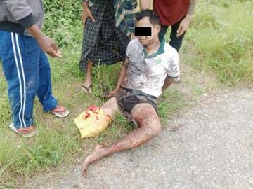 An innocent civilian injured after stepping on a land mine planted by a terrorist group in Loikaw Township of Kayah State.