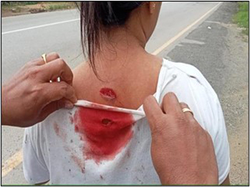An innocent civilian injured in a drone bomb attack by pro-terrorism KNU members and so-called PDF terrorists in Ka Nyunt Kwin Town, Phyu Township, Bago Region.