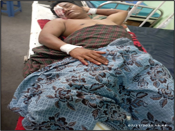 An innocent civilian injured in a heavy weapon attack by so-called PDF terrorists in Watlet Township, Sagaing Region.