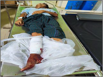 An innocent civilian injured after stepping on a land mine planted by a so-called PDF terrorist group in Salin Township, Magway Region.