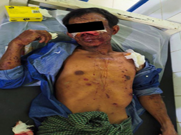 An innocent civilian injured after stepping on a land mine planted by a so-called  PDF terrorist group in Salin Township of Magway Region.