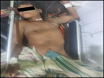 An innocent civilian injured after stepping on a land mine planted by a so-called  PDF terrorist group in Salin Township of Magway Region.
