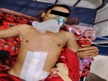An innocent civilian injured in a heavy weapon attack by a combined group of Ta’ang National Liberation Army (TNLA) terrorists and so-called PDF terrorists in Nyaungcho Township of Shan State.