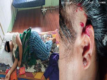 A primary teacher injured in an attack by a so-called PDF terrorist group  in Mahlaing Township of Mandalay Region.
