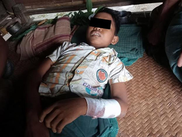 Innocent Civilian injured after stepping on a land mine planted by a so-called PDF terrorist group in Pauk Township of Magway Region.