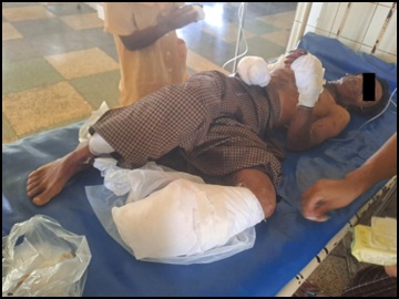 An innocent civilian injured after stepping on an explosive device planted by a so-called PDF terrorist group in Lashio Township of Shan State.