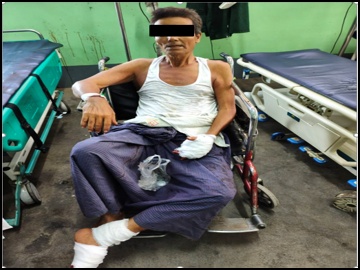 An innocent civilian injured by an explosive device planted by a so-called  PDF terrorist group in Myingyan Township of Mandalay Region.