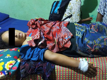 An innocent civilian injured after stepping on an explosive device planted by a combined group of KIA armed insurgents and so-called PDF terrorists in Hpakant Township of Kachin State.