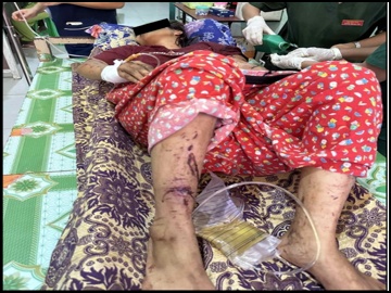 An innocent civilian injured by explosive device planted by a so-called PDF terrorist group in Khin-U Township, Sagaing Region.