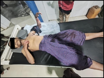 An innocent civilian injured in a heavy weapon attack by a so-called  PDF terrorist group in Salin Township of Magway Region.
