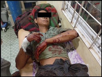 An innocent civilian injured after stepping on an explosive device planted by a so-called PDF terrorist group in Salin Township of Magway Region.