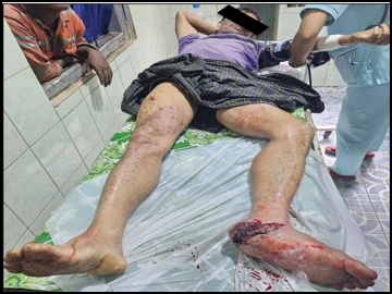 An innocent civilian injured after stepping on an explosive device planted by pro-terrorism KNU members and so-called PDF terrorists in Pharpon Township of Kayin State.
