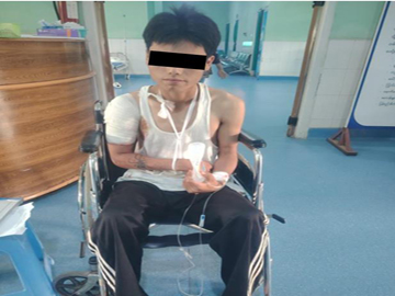 An innocent civilian injured in a heavy weapon attack by Ta'ang National Liberation Army (TNLA) terrorist group in Naungcho Township of Shan State.