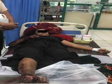 An innocent civilian injured after stepping on a land mine planted by a terrorist group in Hsihseng Township of Shan State.