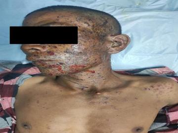 An innocent civilian injured after triggering an explosive device planted by a so-called PDF terrorist group in Pwintphyu Township of Magway Region.
