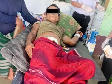 An innocent civilian injured in a heavy weapon attack by a combined group of KNU and  so-called PDF terrorists in Hpa-an Township of Kayin State.