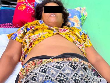 An innocent civilian injured in a heavy weapon attack by a so-called PDF terrorist group in Shwebo Township of Sagaing Region.