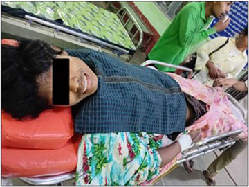 An innocent civilian injured in an attack by a combined group of KNU and   so-called PDF terrorists in Myawaddy Township of Kayin State.