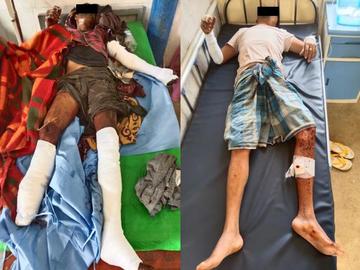 ရှမ်းပြည်နယ်၊ နောင်ချိုမြို့နယ်၌ TNLA အကြမ်းဖက်သမားများ ထောင်ထားသည့် နင်းမိုင်း  တစ်လုံးအား နင်းမိပေါက်ကွဲခဲ့မှုကြောင့် အပြစ်မဲ့ အရပ်သားပြည်သူ နှစ်ဦး  ထိခိုက်ဒဏ်ရာရရှိမှု မှတ်တမ်းဓာတ်ပုံ။