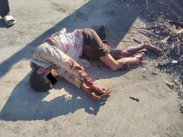 ကယားပြည်နယ်၊ လွိုင်ကော်မြို့နယ်၌ PDF အမည်ခံ အကြမ်းဖက်သမားများ ထောင်ထားသည့်  နင်းမိုင်း တစ်လုံးအား နင်းမိပေါက်ကွဲခဲ့မှုကြောင့် အပြစ်မဲ့ အရပ်သားပြည်သူ တစ်ဦး  ထိခိုက်ဒဏ်ရာရရှိမှု မှတ်တမ်းဓာတ်ပုံ။