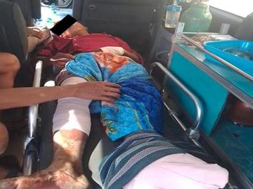 An innocent civilian injured after stepping on an improvised explosive device  planted by so-called PDF terrorists in Dawei Township of Tanintharyi Region.