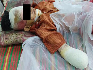 A child injured after stepping on an improvised explosive device planted by   so-called PDF terrorists in Dawei Township of Tanintharyi Region.
