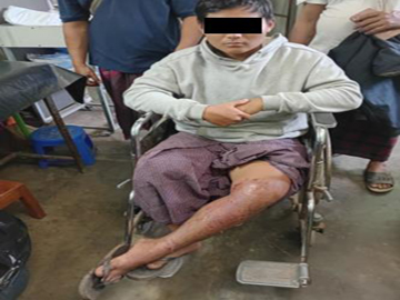 An innocent civilian injured in an improvised explosive device explosion   planted by a combined group of KNU and so-called PDF terrorists in Hpa-an   Township of Kayin State.