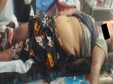 An innocent civilian injured after stepping on an improvised explosive device planted by so-called PDF terrorists in Madaya Township of Mandalay Region.