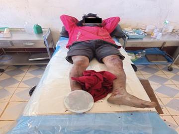 An innocent civilian injured after stepping on an improvised explosive device planted by the so-called CDF terrorists in Hakha Township of Chin State.