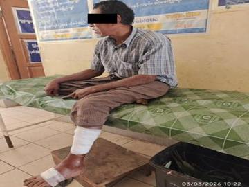 An innocent civilian injured in an improvised explosive device explosion planted by so-called PDF terrorists in Kambalu Township of Sagaing Region.