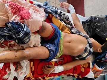 ချင်းပြည်နယ်၊ ဖလမ်းမြို့နယ်၌ CDF အကြမ်းဖက်အဖွဲ့က ပစ်ချထားခဲ့သည့် ဗုံးသီးဟောင်း  တစ်လုံး ပေါက်ကွဲခဲ့မှုကြောင့် ကလေးငယ် တစ်ဦး ထိခိုက်ဒဏ်ရာရရှိမှု မှတ်တမ်းဓာတ်ပုံ။